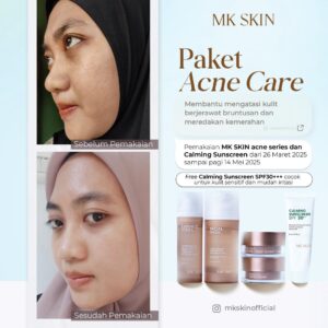 Testi Acne #1