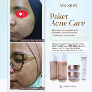 Testi Acne #3