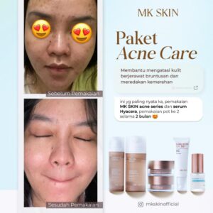 Testi Acne #4