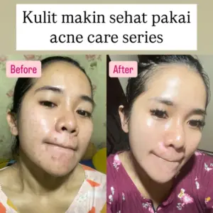 ACNE SERIES
