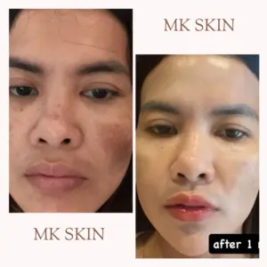 BEFORE - AFTER MELASMA